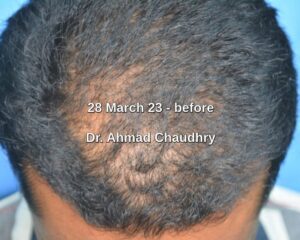 Exosome hair therapy for hair regeneration...