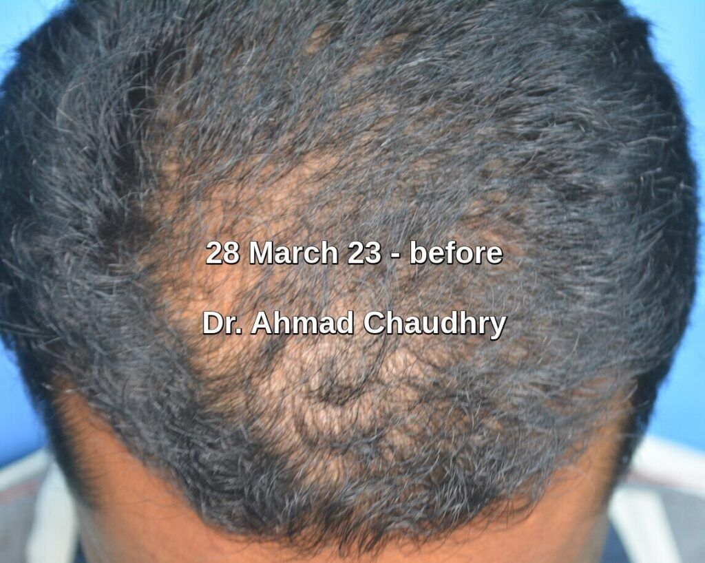 Exosome hair therapy for hair regeneration...
