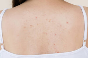 Body Acne
